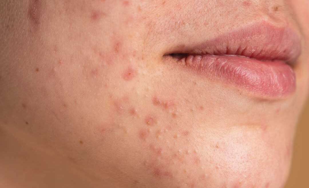 Dermatology