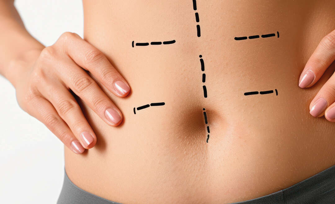 Abdominoplasty Cost