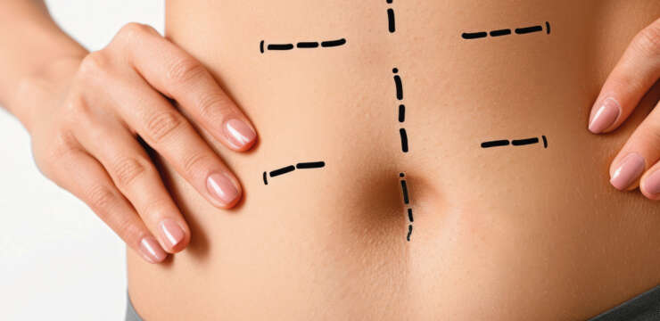 Abdominoplasty Cost