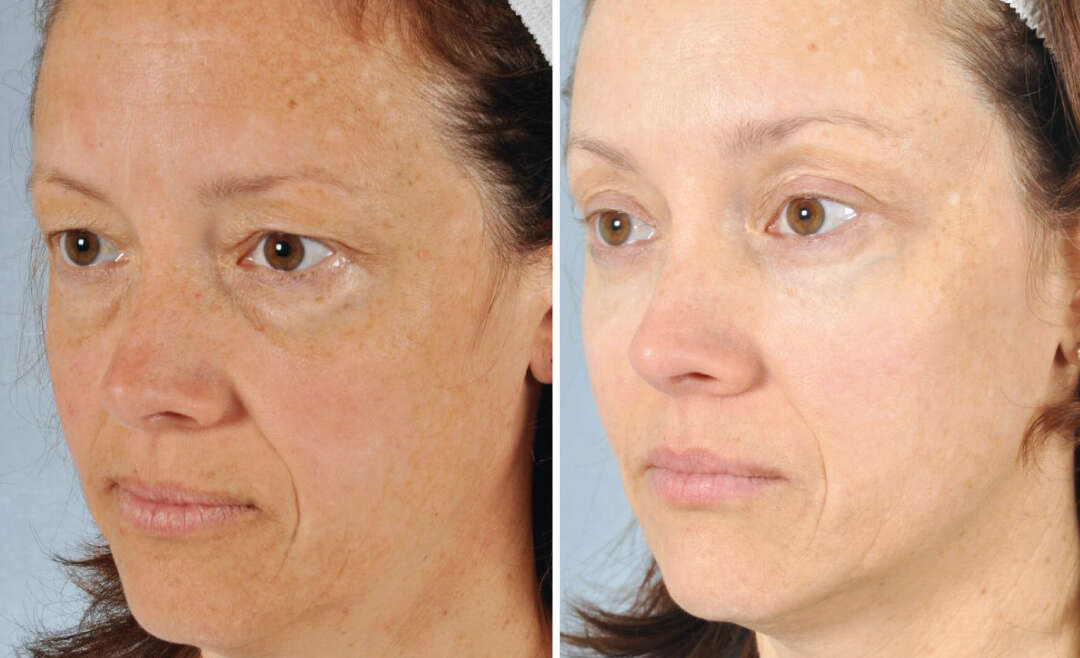 Blepharoplasty Before and After