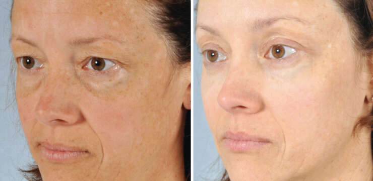 Blepharoplasty Before and After