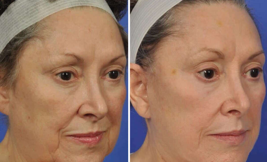 Facelift Before and After