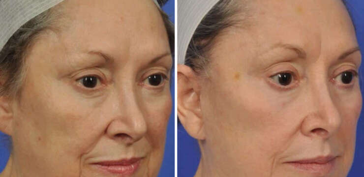 Facelift Before and After