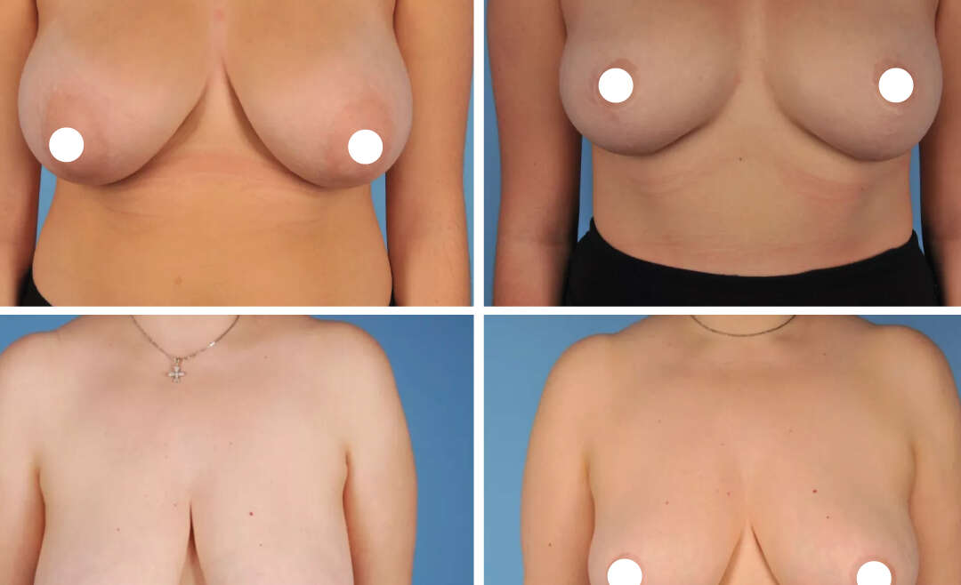 Mammoplasty Before and After