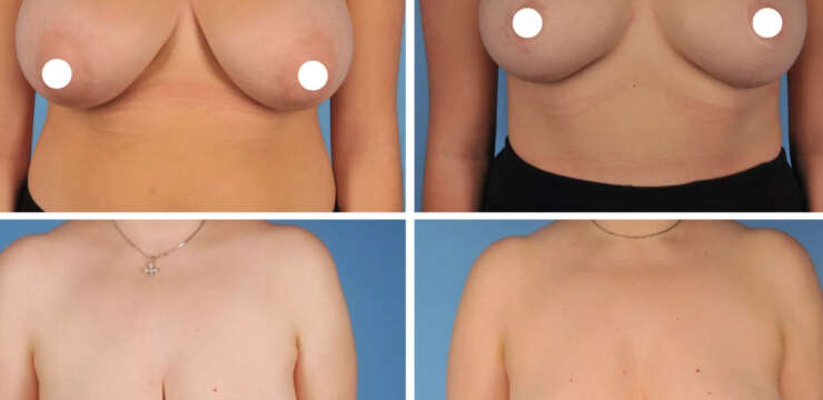 Mammoplasty Before and After