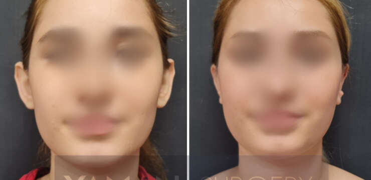 Is a Nose Job Permanent