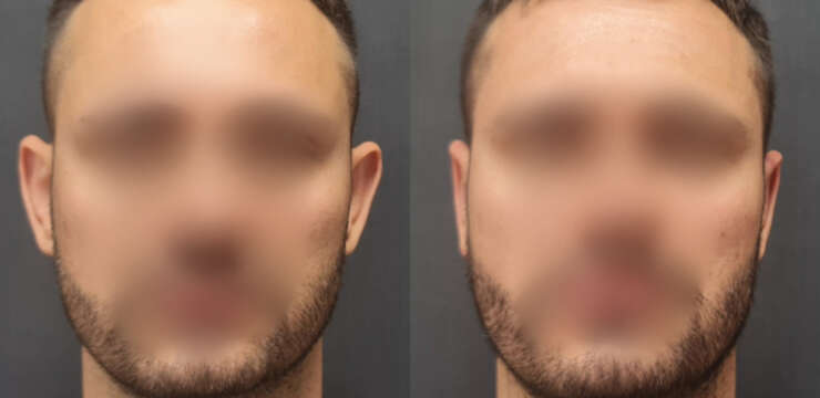 Otoplasty Before and After
