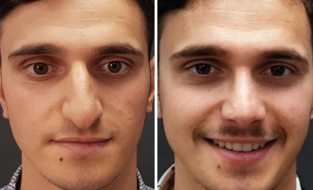 Rhinoplasty Nose Reduction