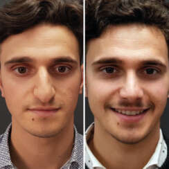 Rhinoplasty Nose Reduction