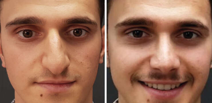 Rhinoplasty Nose Reduction