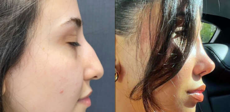 Rhinoplasty Before and After