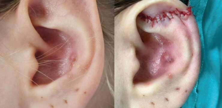 What’s the Difference between Earlobe Repair