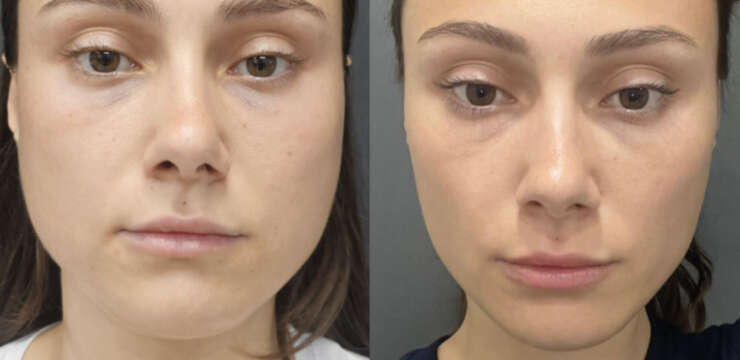 Cost of Buccal Fat Removal