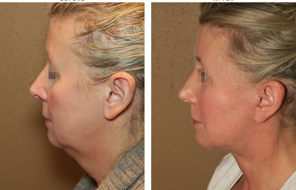 Neck Liposuction in Turkey