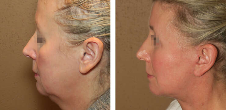 Neck Liposuction in Turkey