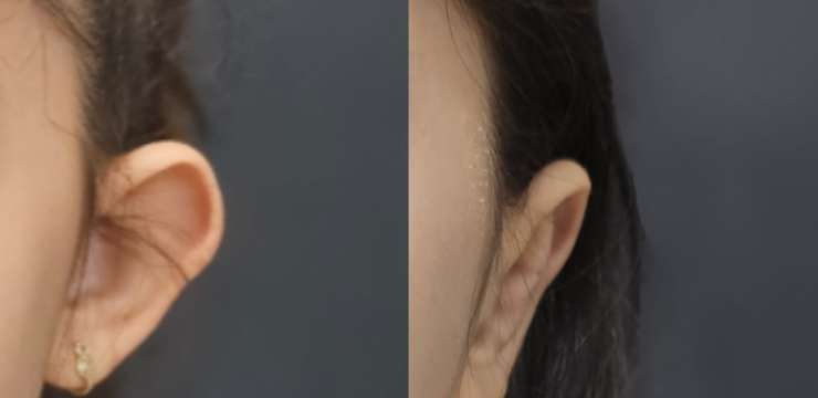 Ear Pinning Surgery in Turkey