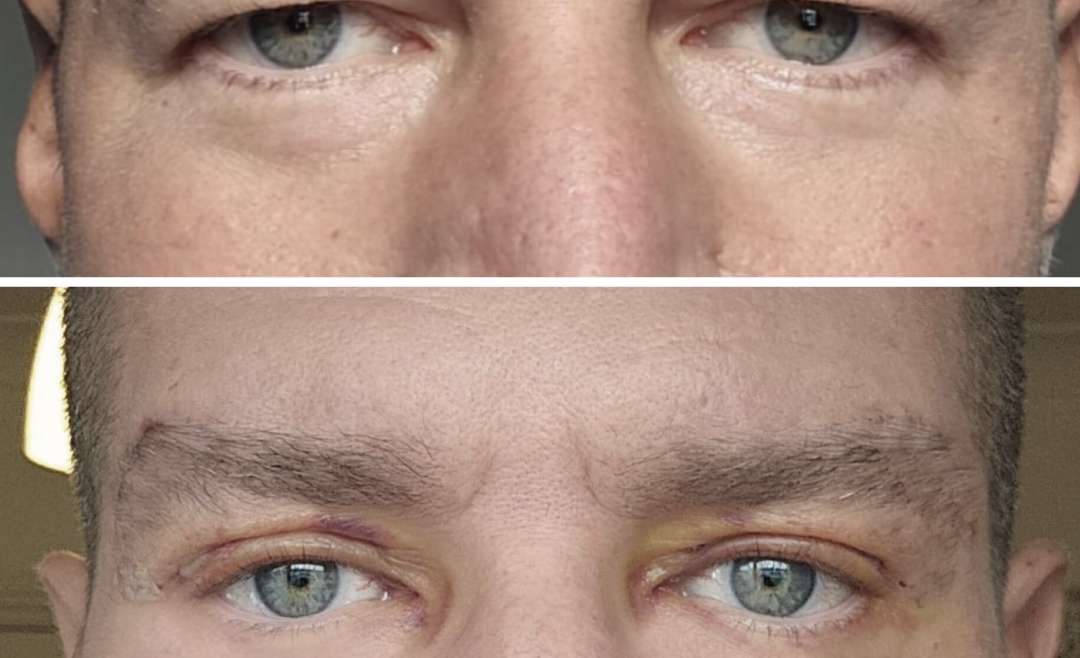 What is the Best Age for Blepharoplasty