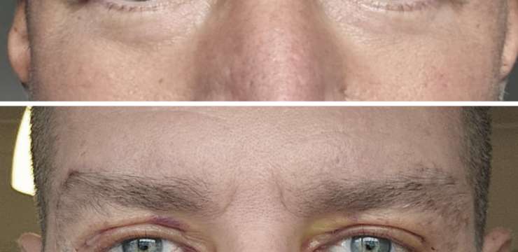 What is the Best Age for Blepharoplasty