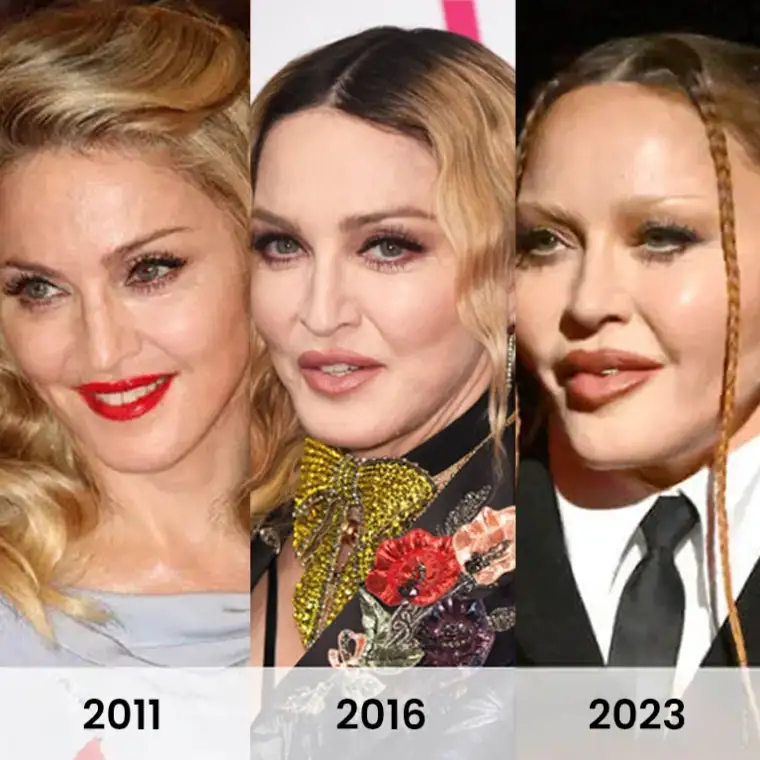 Madonna Plastic Surgery