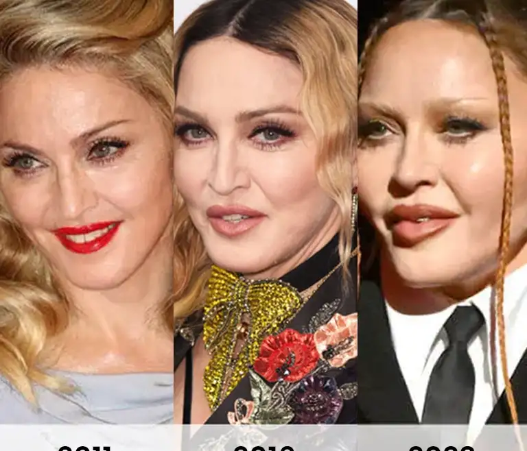 Madonna Plastic Surgery