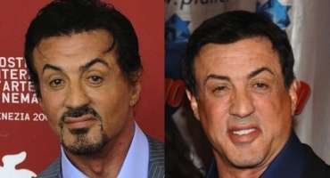 Stallone Plastic Surgery