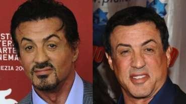 Stallone Plastic Surgery