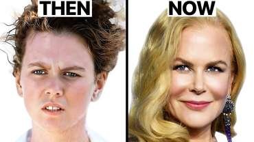 Nicole Kidman Plastic Surgery