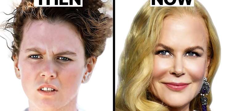 Nicole Kidman Plastic Surgery