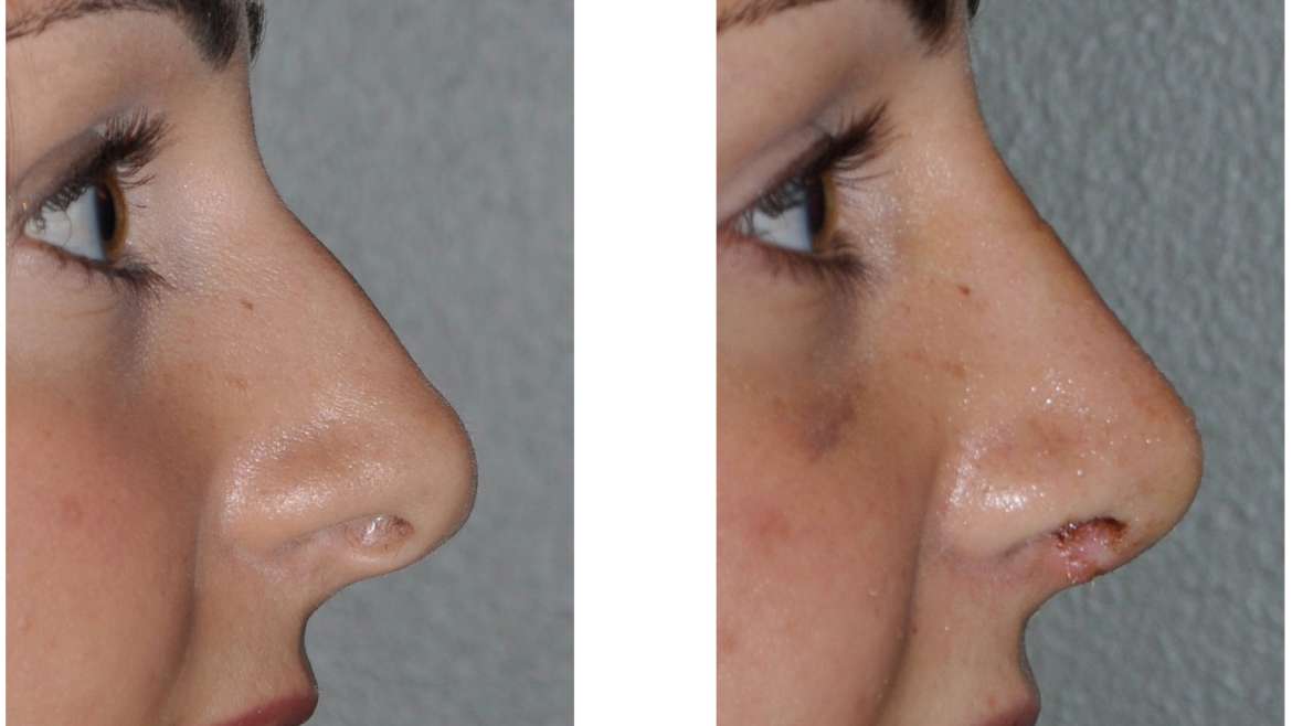 Rhinoplasty Healing