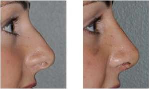 Rhinoplasty Healing