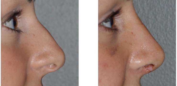Rhinoplasty Healing