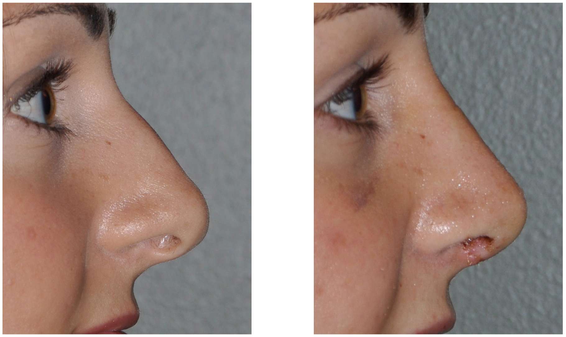 Rhinoplasty Healing