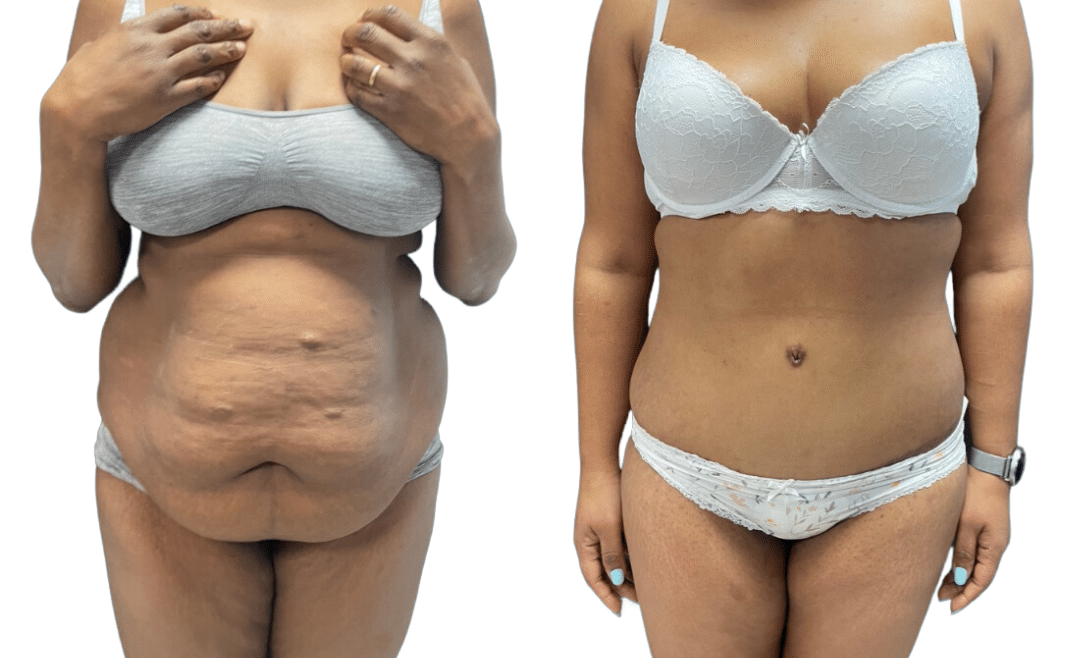 Mommy Makeover in Turkey