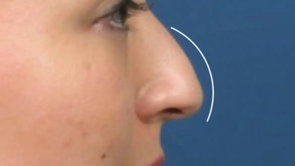 What is a Droopy Nose