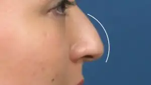 What is a Droopy Nose