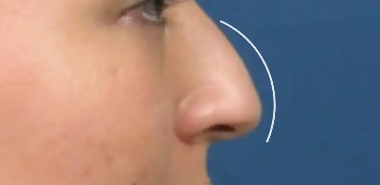 What is a Droopy Nose