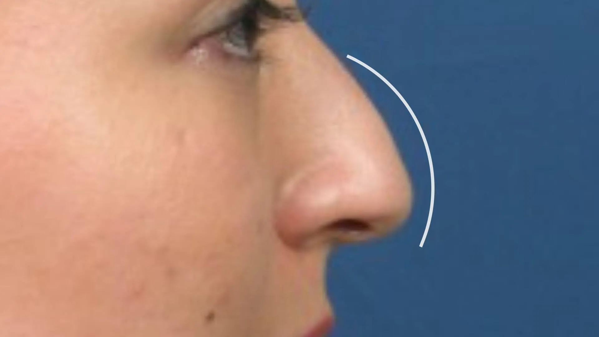 What is a Droopy Nose