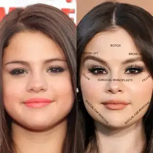 Did Selena Gomez Get Plastic Surgery