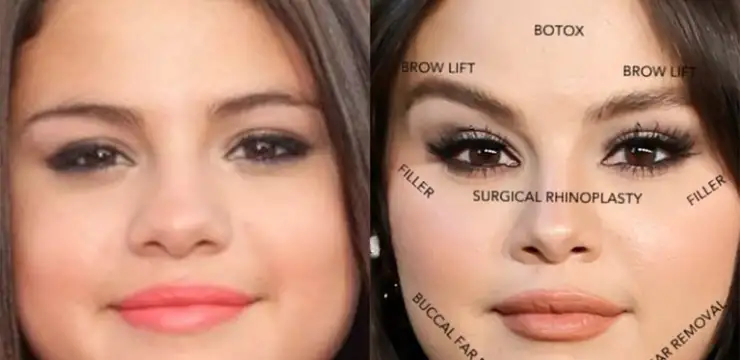 Did Selena Gomez Get Plastic Surgery