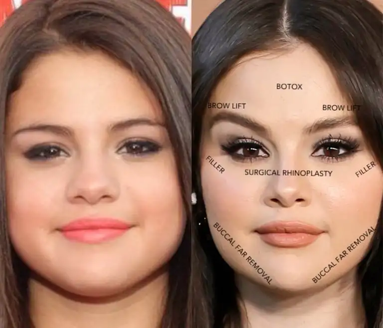 Did Selena Gomez Get Plastic Surgery
