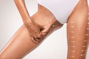 What are the Types of Thighplasty