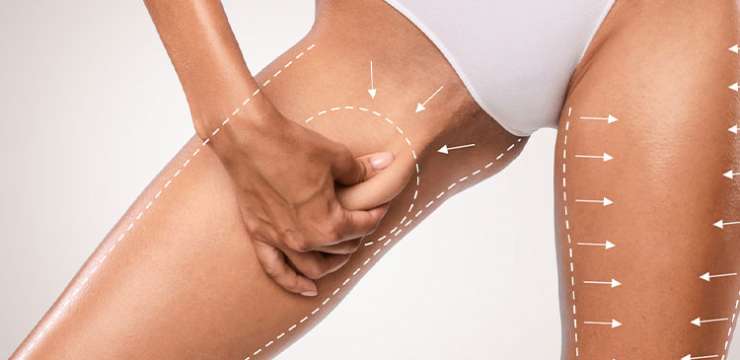 What are the Types of Thighplasty
