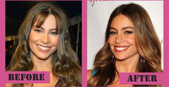 Did Sofia Vergara Get Plastic Surgery