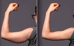 Brachioplasty