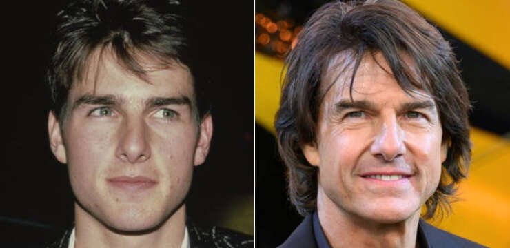 Tom Cruise Facial Plastic Surgeries
