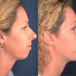 Chin Surgery in Turkey