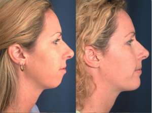 Chin Surgery in Turkey