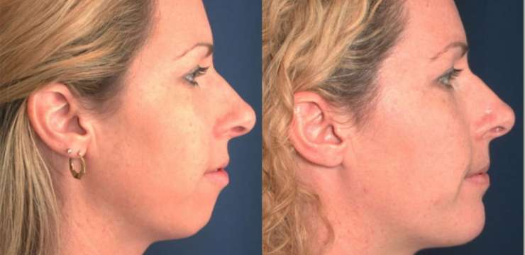 Chin Surgery in Turkey
