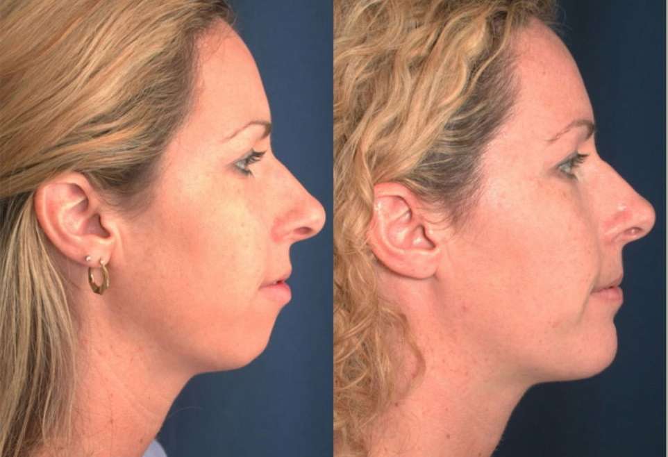 Chin Surgery in Turkey