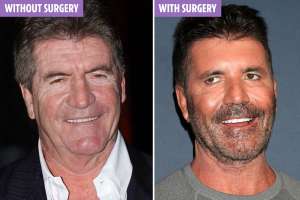Simon Cowell Facial Surgery
